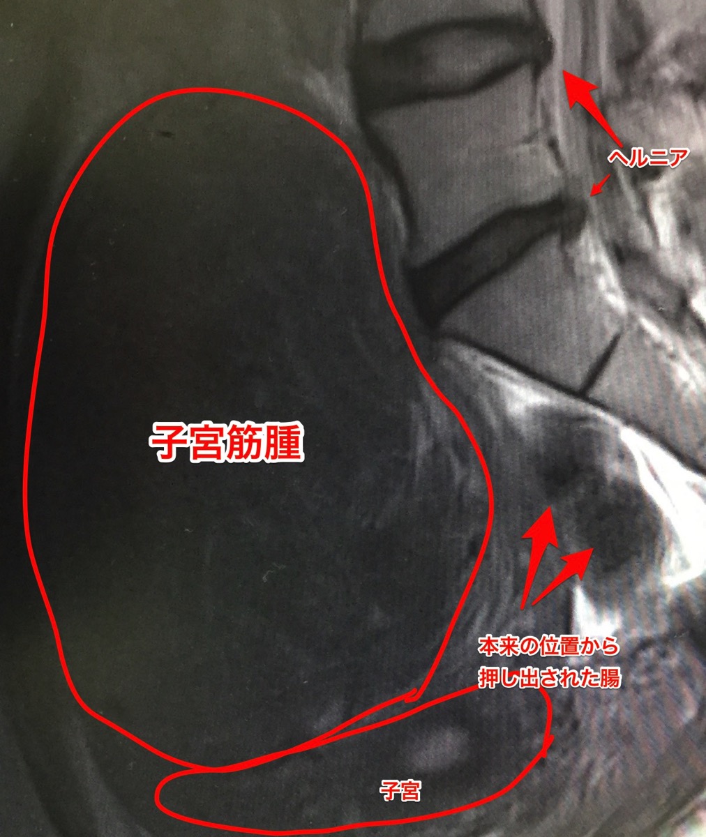 体験 手術 談 筋腫 子宮 子宮筋腫の手術を受けました。